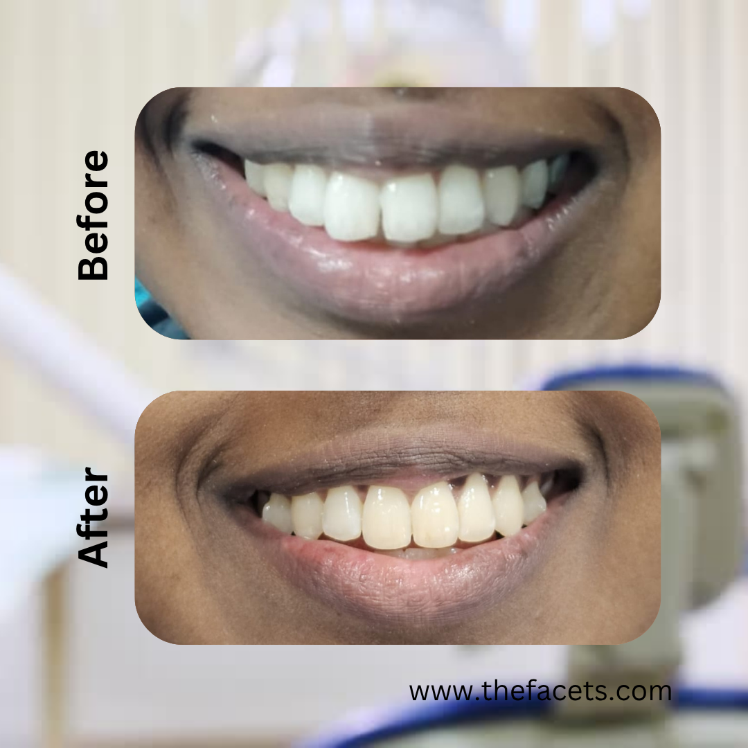 Before After Result 3
